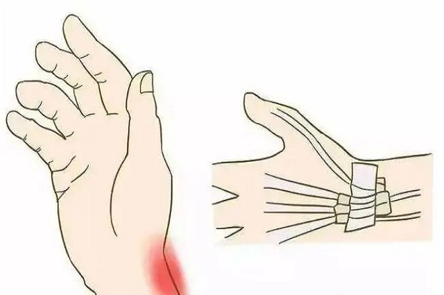 手腕一用力或旋转就疼治疗方法(图1)