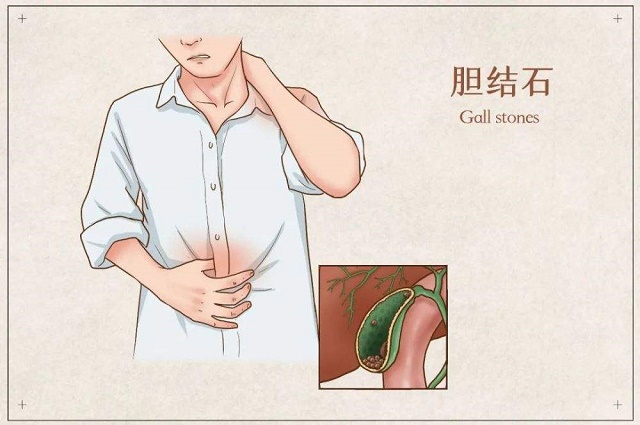 胆结石背痛位置图图片