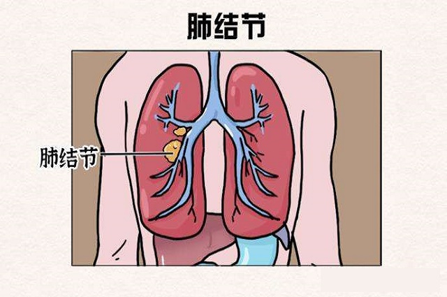 肺部结节怎么消除(图1)