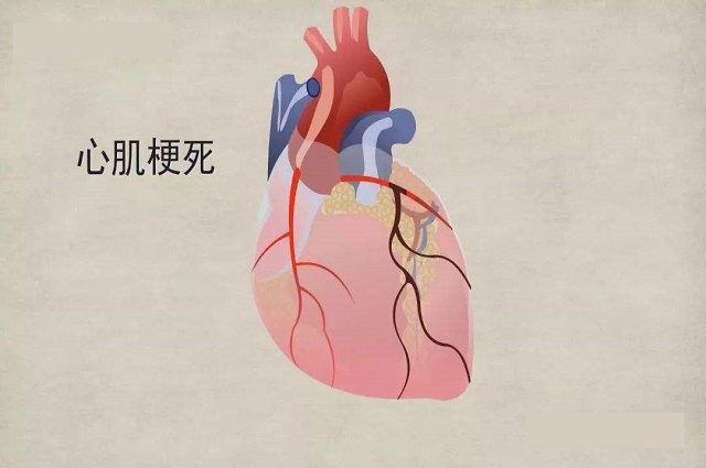 急性心梗和慢性心梗区别(图1)