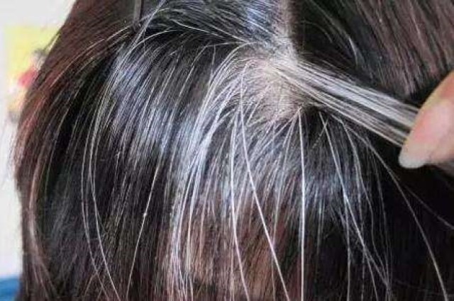 白头发如何根治才能变成黑头发(图1)