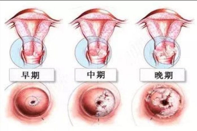 宫颈癌早期能治愈吗(图1)