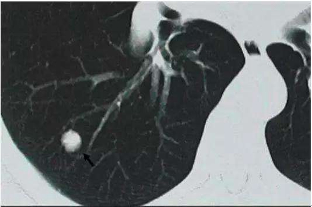 肺结节是怎么形成的怎样才能消除(图1)