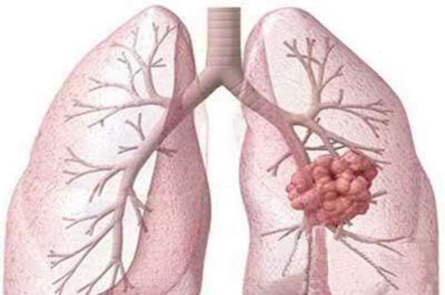 肺痨的症状有哪些(图1)