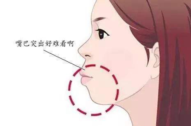 口呼吸脸型还能矫正吗(图1)