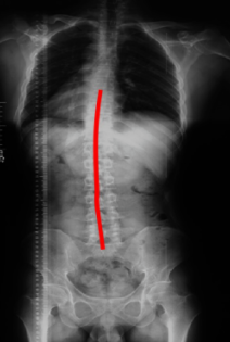 脊柱侧弯1到10度图片(图2)