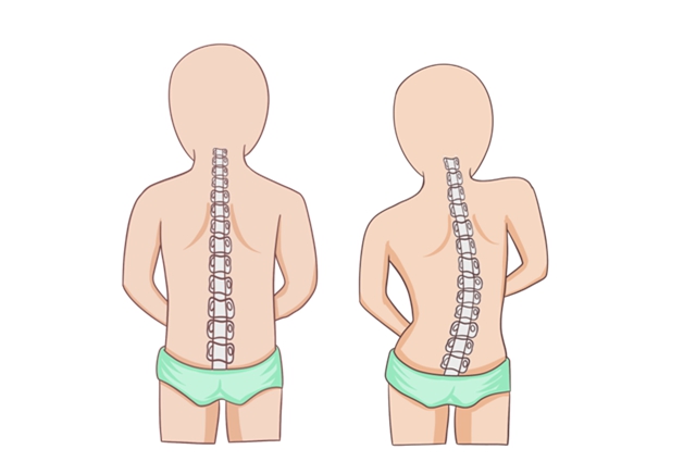 脊柱侧弯是怎么引起的(图1)
